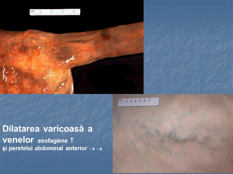 Dilatarea varicoasă a venelor  esofagiene   şi peretelui abdominal anterior  